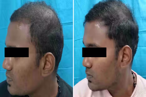 Hair loss in men